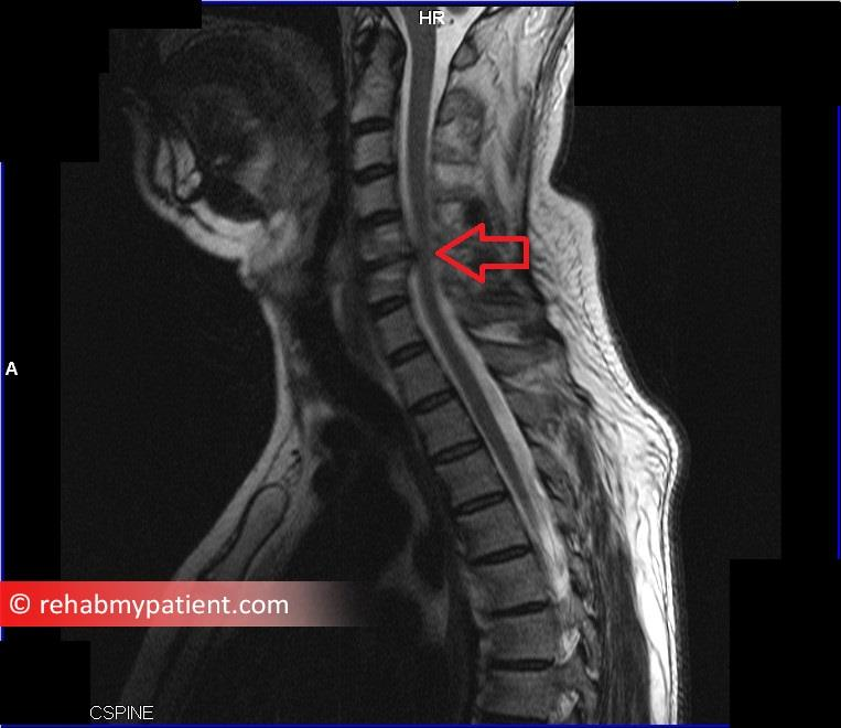 Outlaw Formindske Spille computerspil Cervical Radiculopathy (Pinched Nerve) | Rehab My Patient