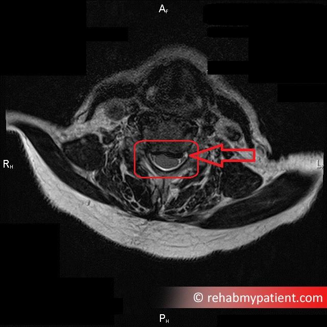 Cervical Radiculopathy Scan