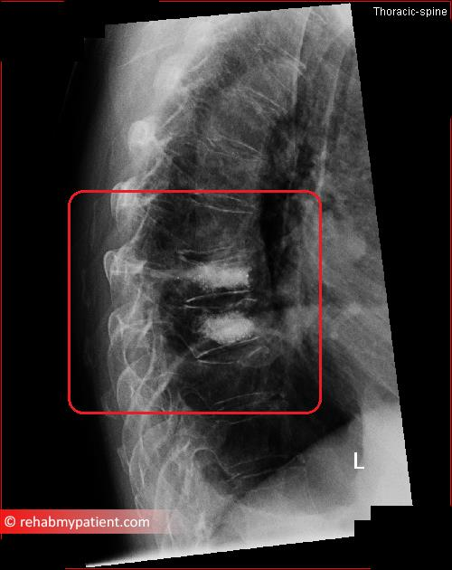 Kyphoplasty X Ray