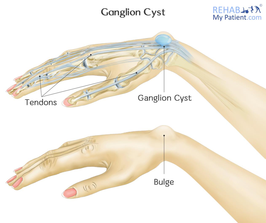 Ganglion Cyst