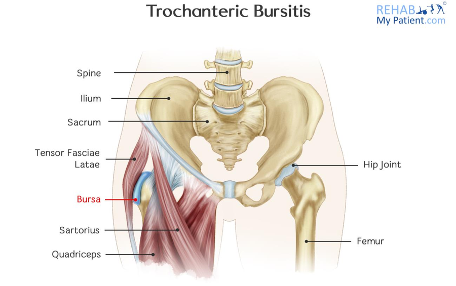 Trochanteric Hip Bursitis