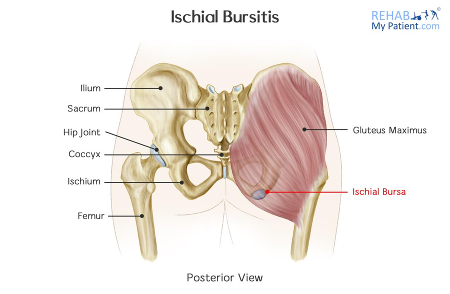 Ischial Bursitis