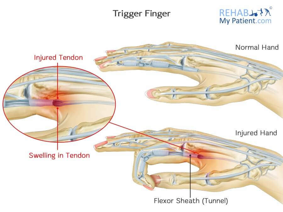 Triger Finger Anatomy