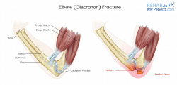 Elbow (Olecranon) Fracture