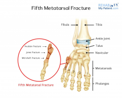 Fifth Metatarsal Fracture