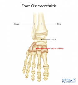 Foot Osteoarthritis