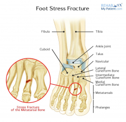 Foot Stress Fracture