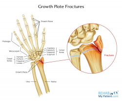 Growth Plate Fractures