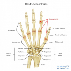 Hand Osteoarthritis