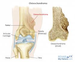 Osteochondroma