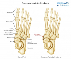 ankle navicular accessory syndrome articles