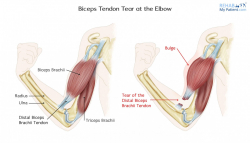 Biceps Tendon Tear at the Elbow