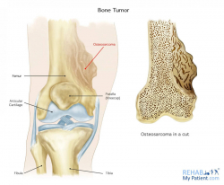 Bone Tumor (Osteochondroma)