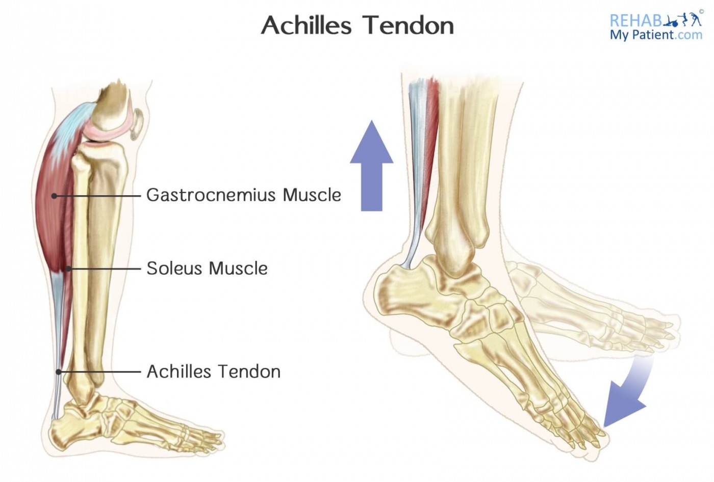 Torn Achilles Cast