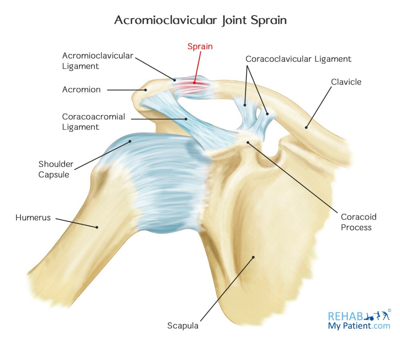 Acromioclaviculargelenkluxation