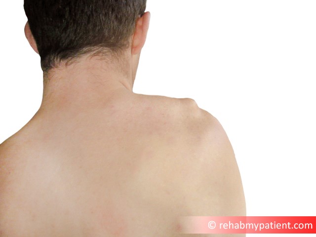 Lump On Shoulder Blade Bone It Exists For Informational Purposes Only