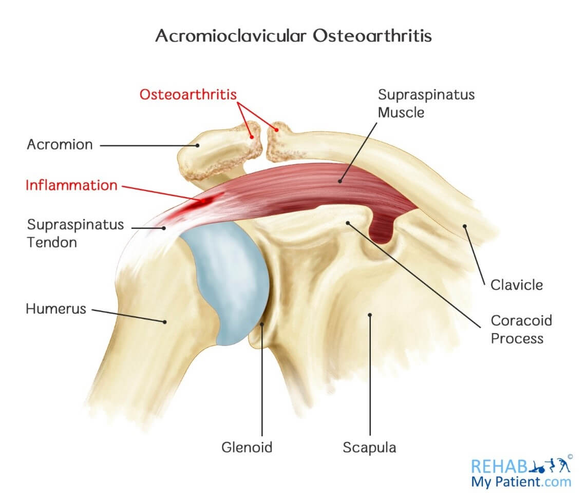 accident Diacritical skin Acromioclavicular Osteoarthritis | Rehab My Patient