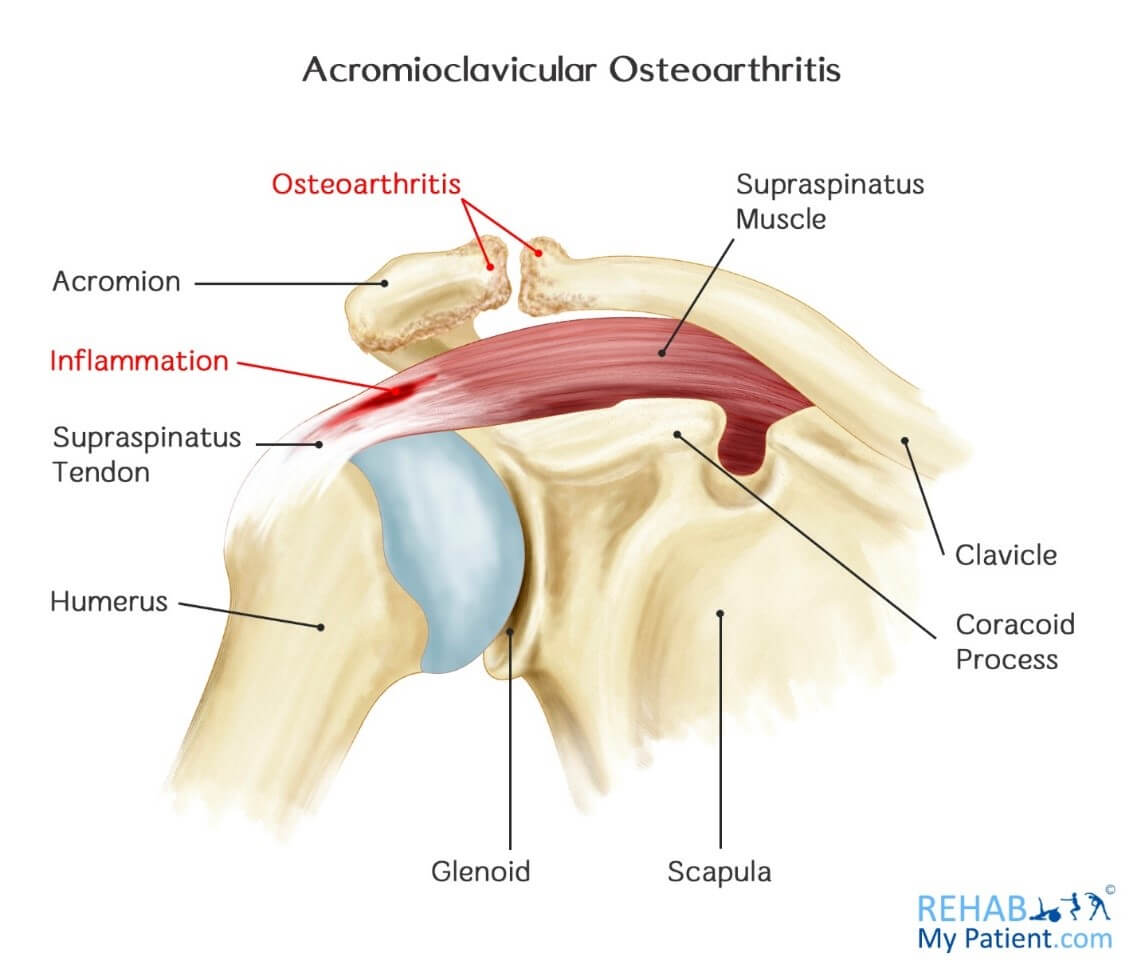 Посттравматический латынь. Воспаление акромиально-ключичного сочленения. Акромиально-ключичный сустав мышцы. Артроз акромиально-ключичного сочленения плечевого сустава. Акромиально-ключичный сустав 2 степени.