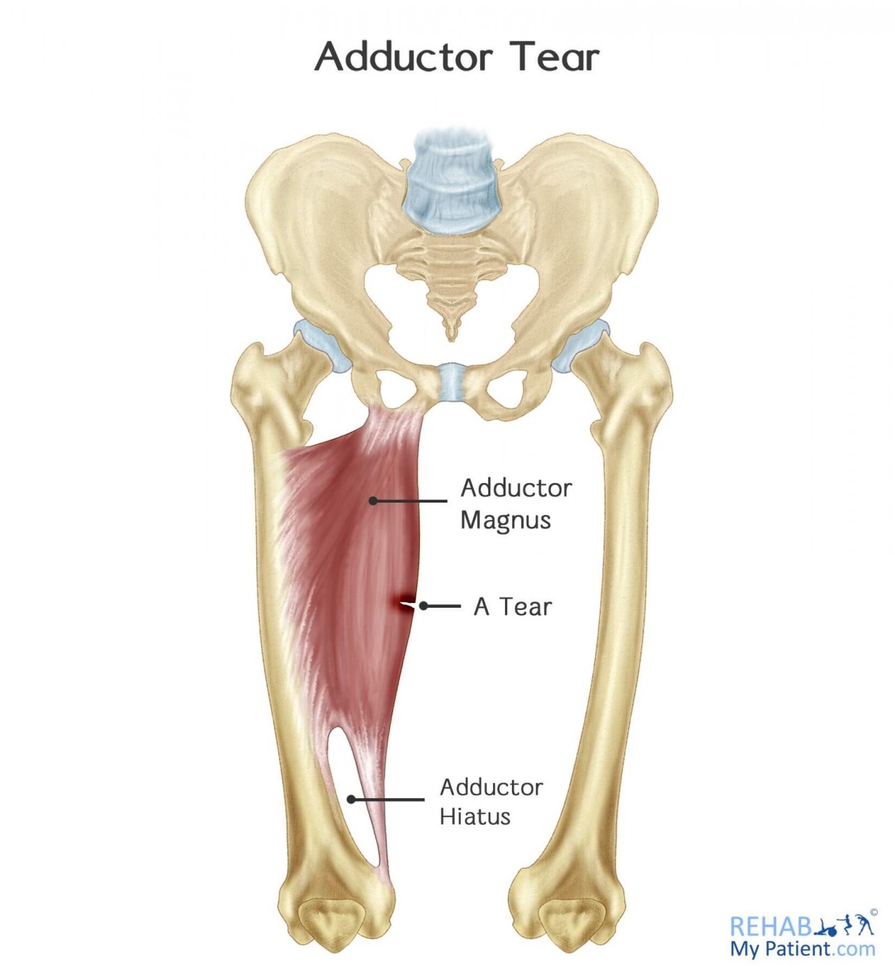 Adductor Tear