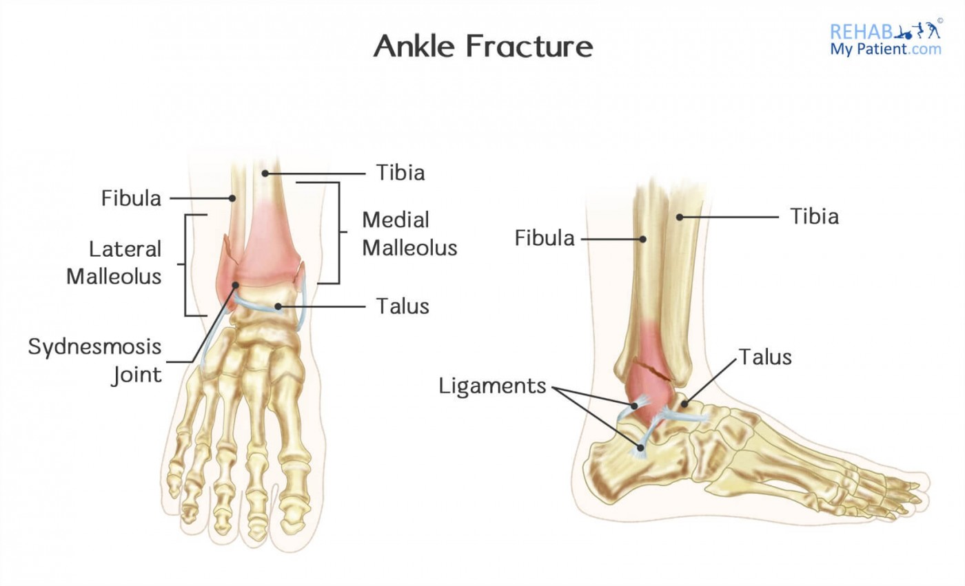 Ankle Fracture Rehab My Patient