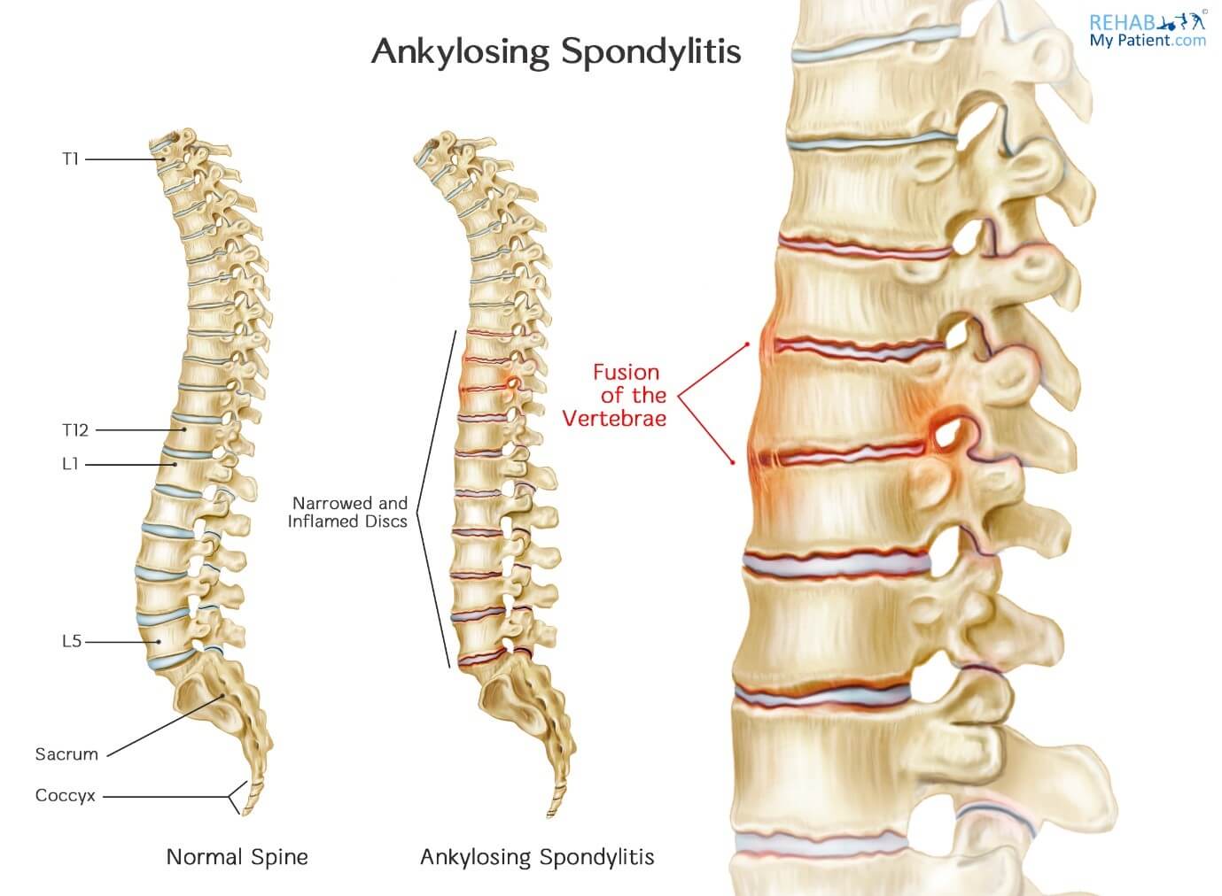 Ankylosing Spondylitis