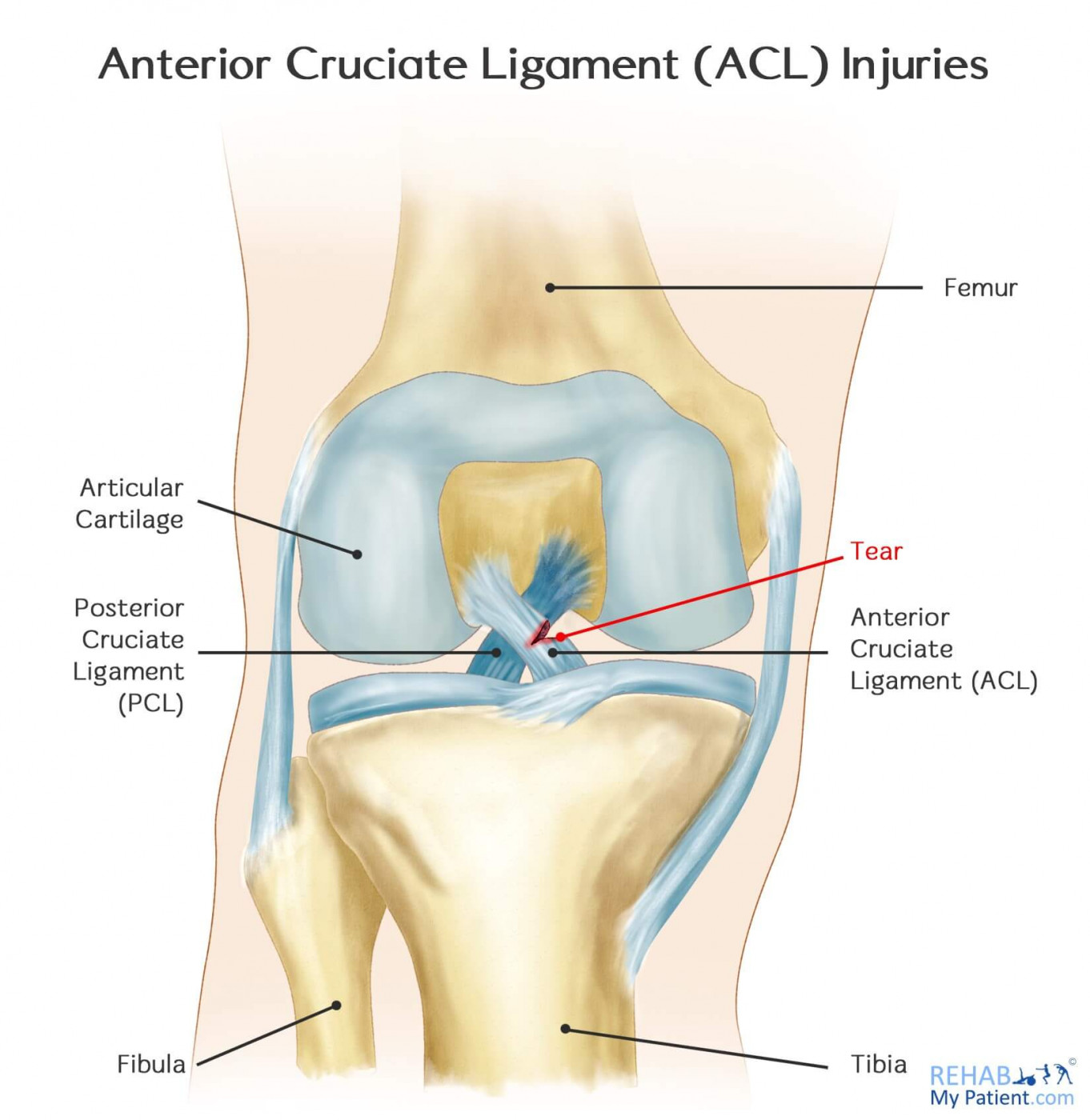 Anterior Cruciate Ligament Injuries