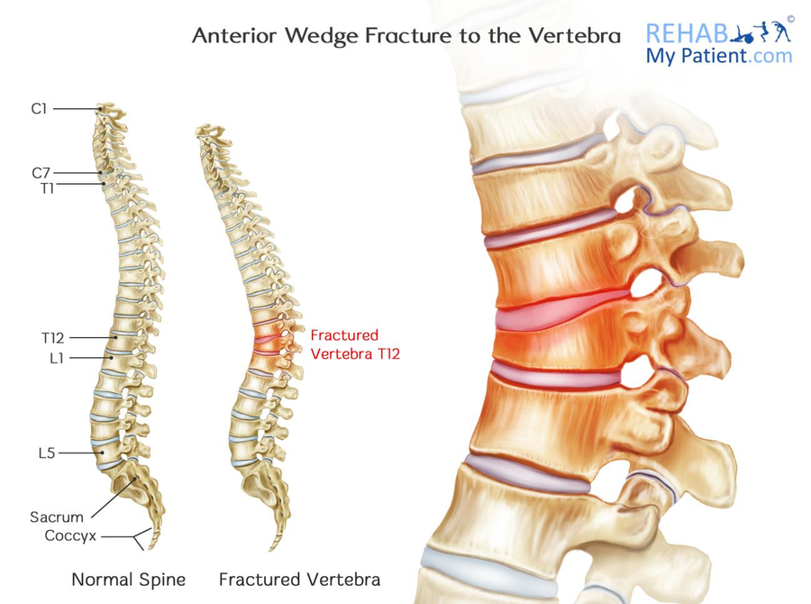 Compression fractures of the back Information