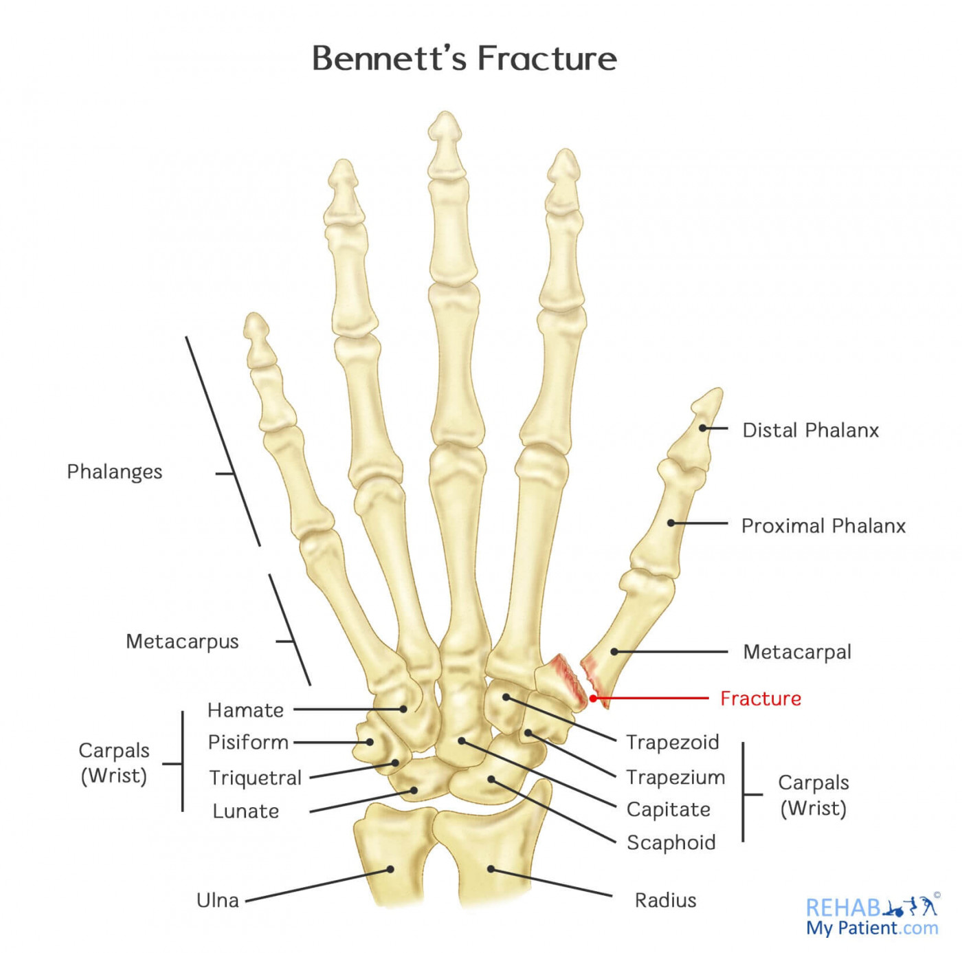 Bennett's Fracture