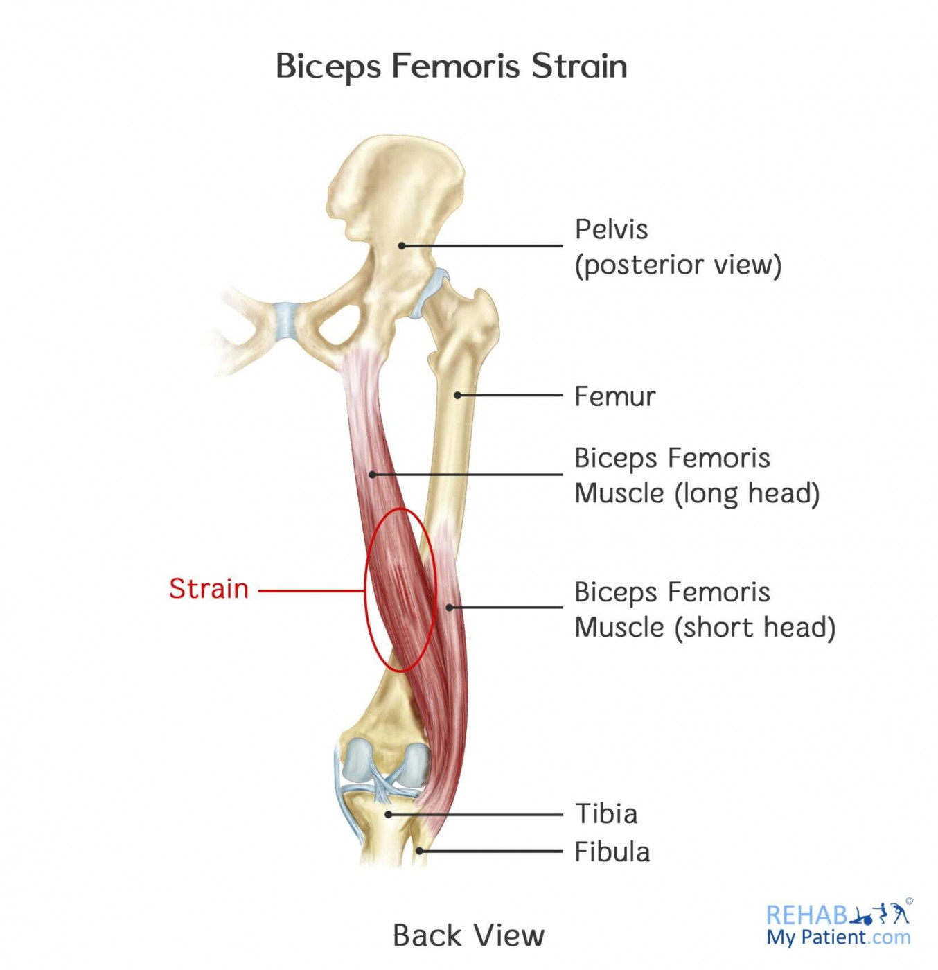 Biceps Femoris Strain