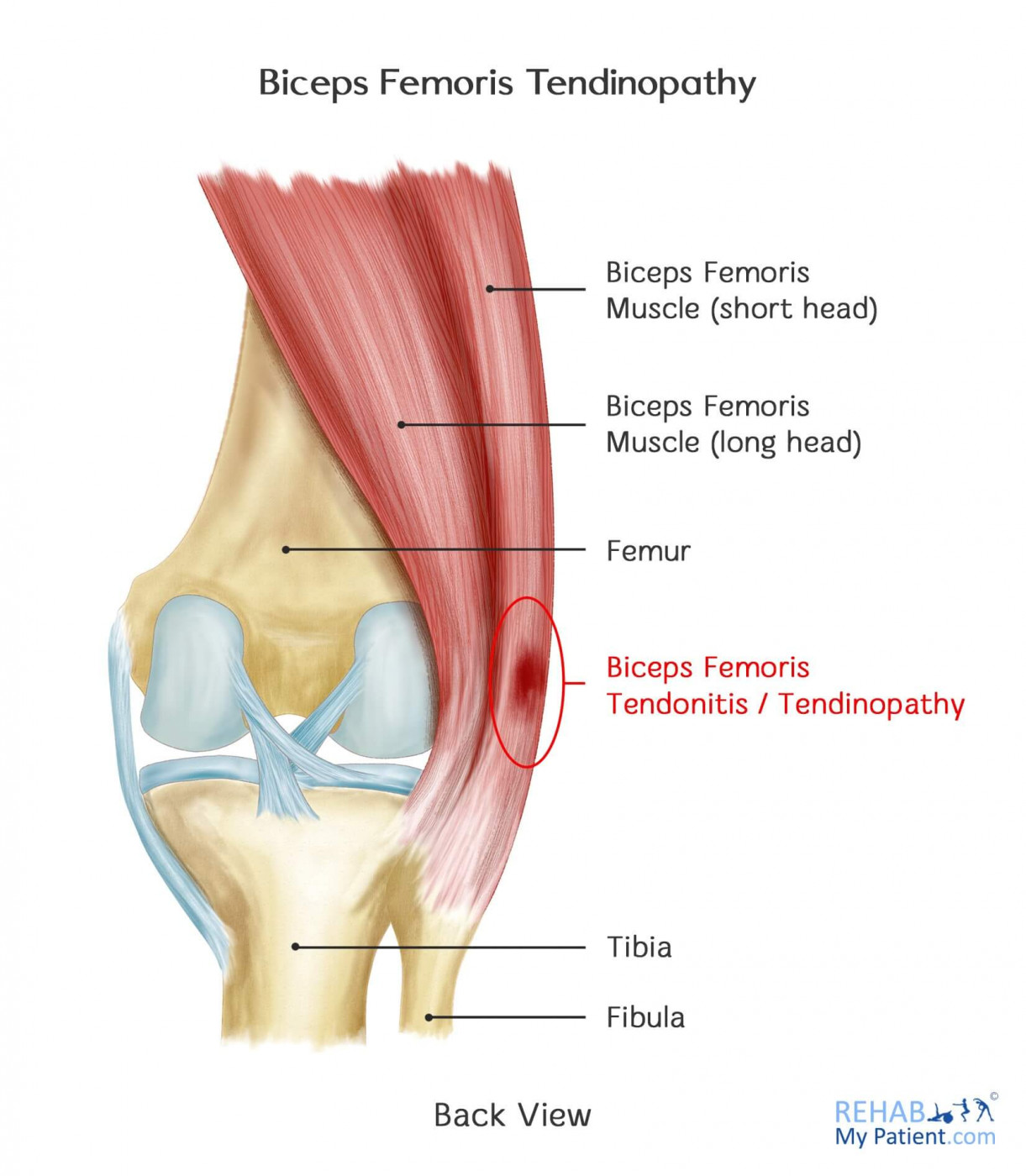 Biceps Femoris Tendinopathy