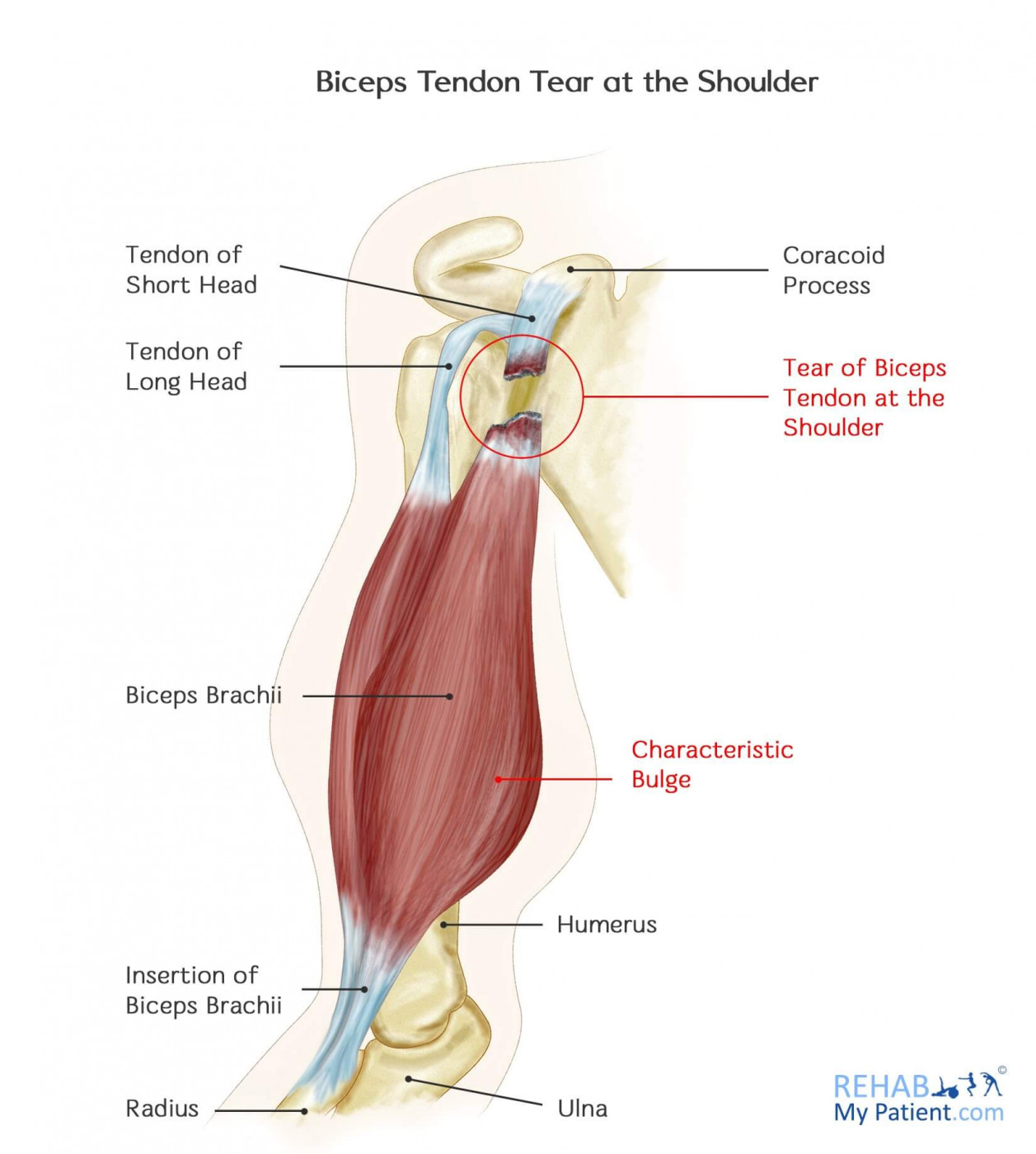 Biceps Tendon Tear at the Shoulder