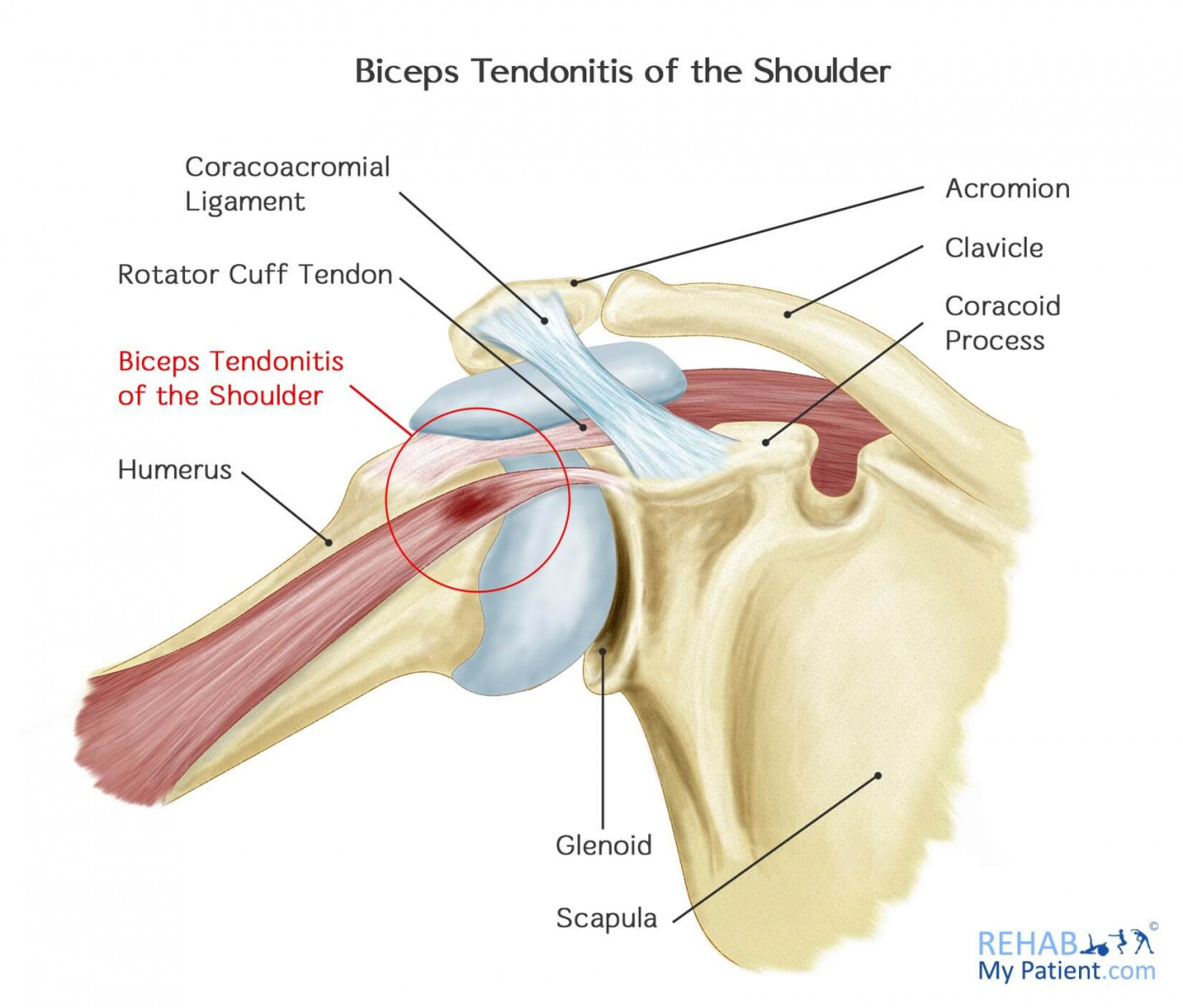 Biceps Tendonitis of the Shoulder