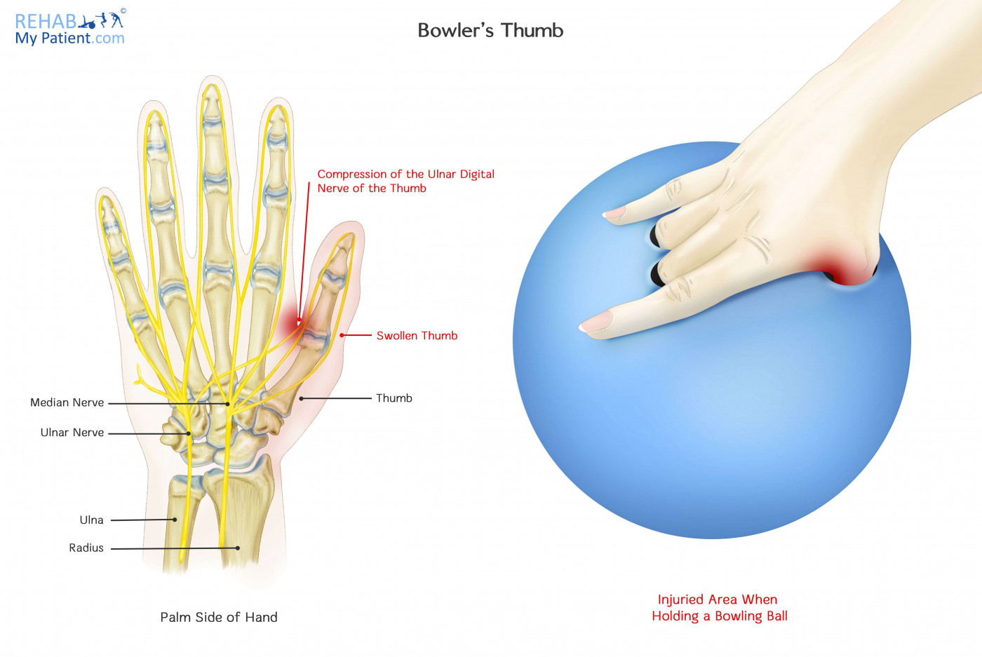 Bowler’s Thumb