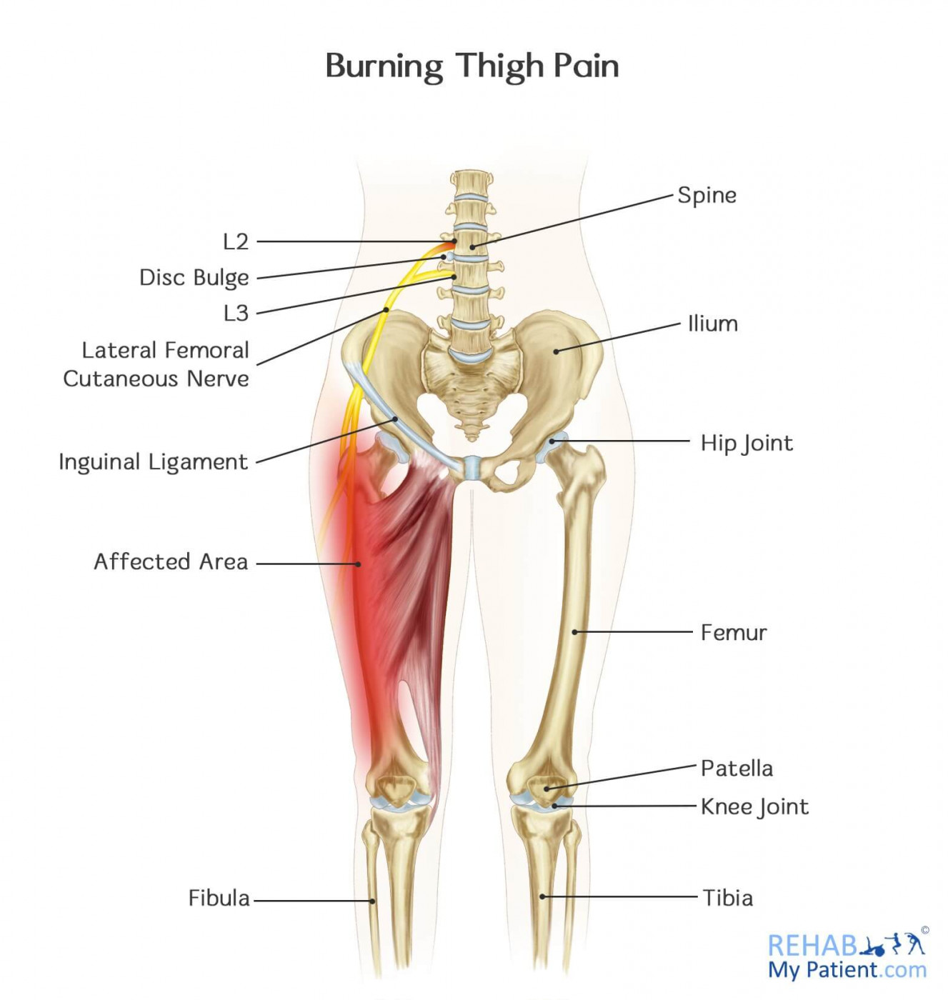 Burning Thigh Pain