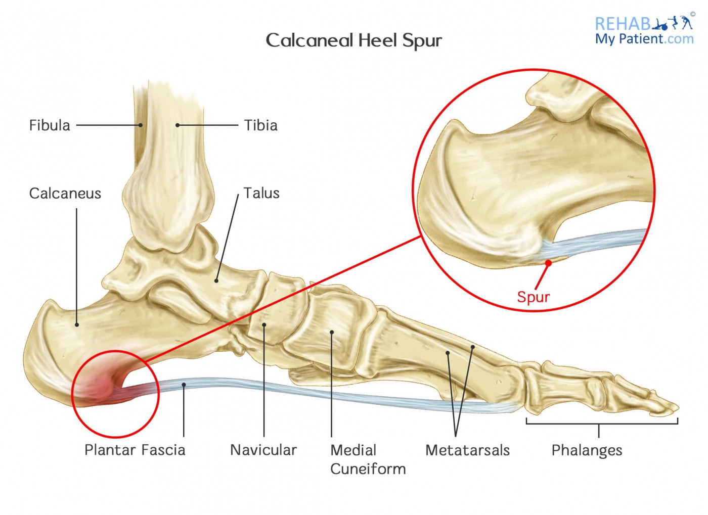 Heel spur, plantar fascia :: KK PHYSIOTHERAPY