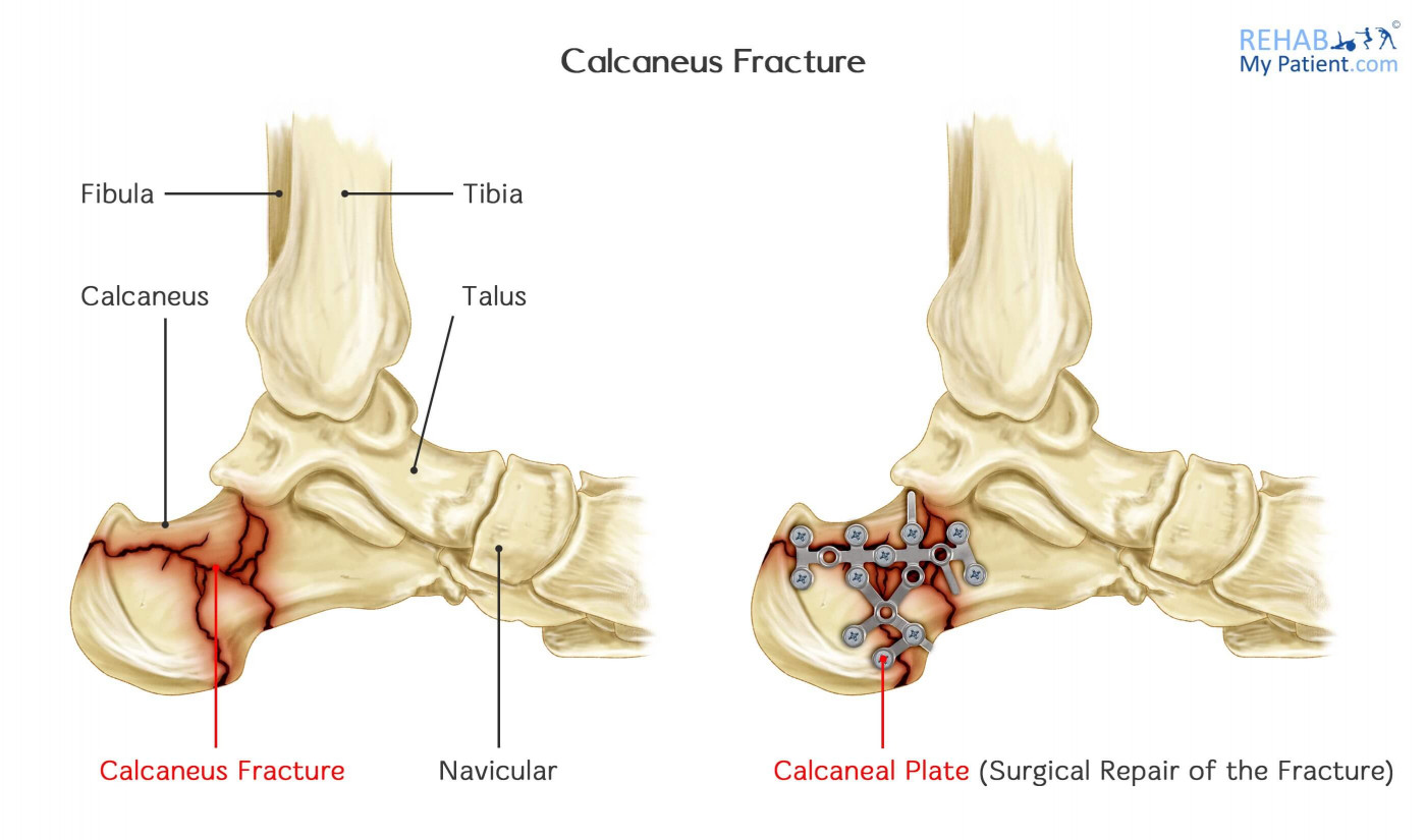 Calcaneus Fracture