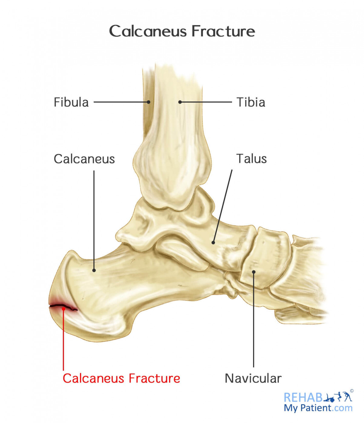 Calcaneus Bone Anatomy Function Calcaneus Pain Calcaneus Fracture | Hot ...