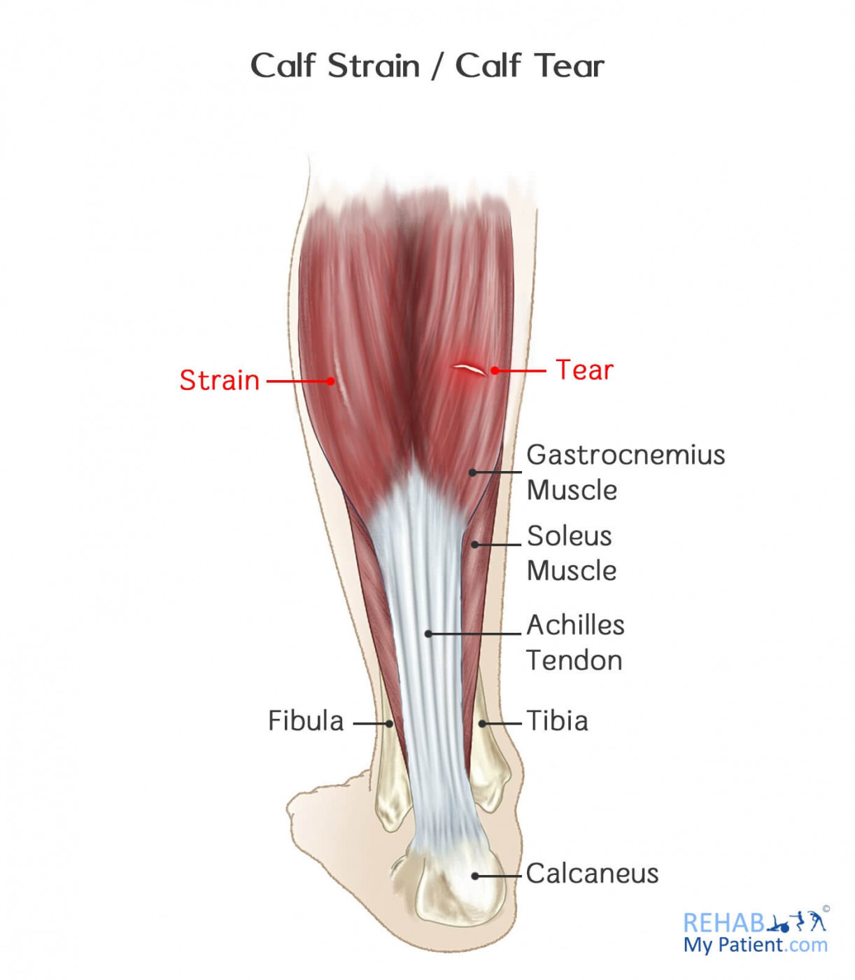 Calf Strain / Calf Tear | Rehab My Patient