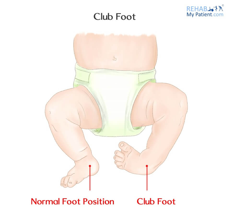 Club foot in a baby
