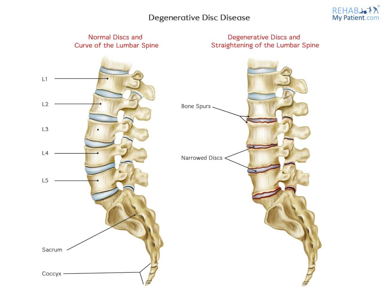 Degenerative Disc Disease