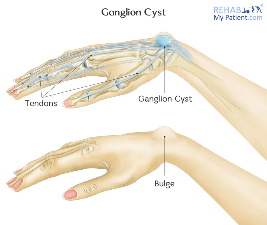 Ganglion Cyst of the Wrist and Hand | Rehab My Patient