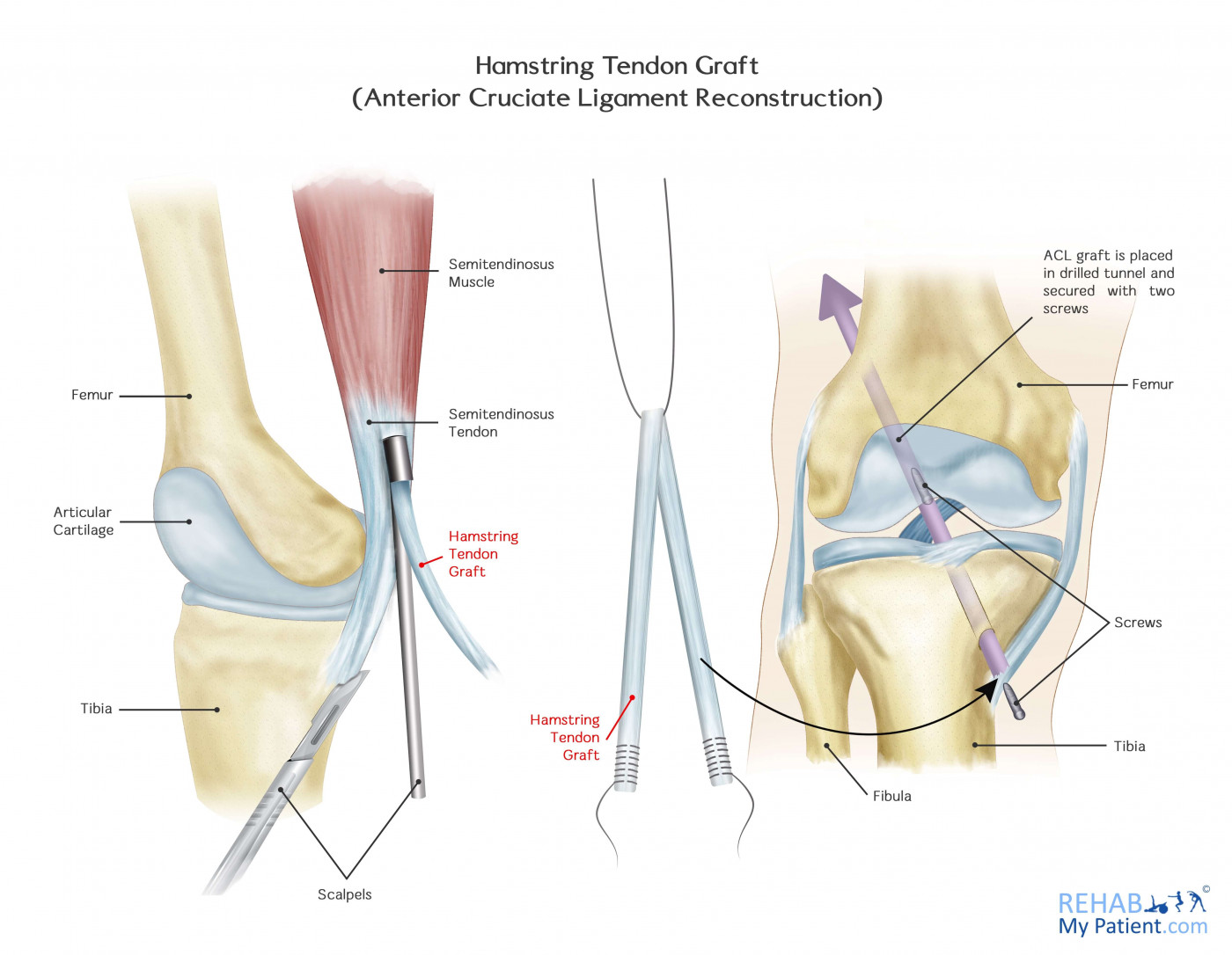 Anterior Cruciate Ligament Rupture and Reconstruction