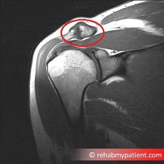 durere la nivelul coloanei vertebrale sacrale durere ascuțită în articulațiile degetelor de la picioare