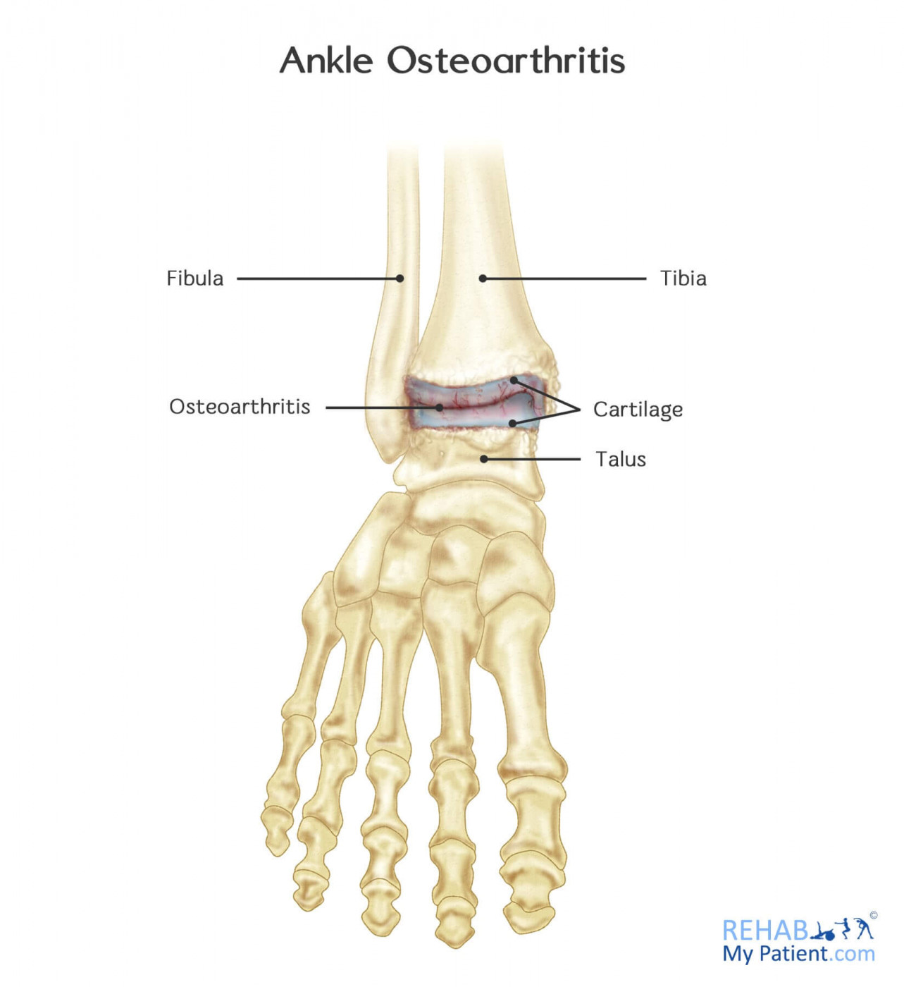 Ankle Osteoarthritis