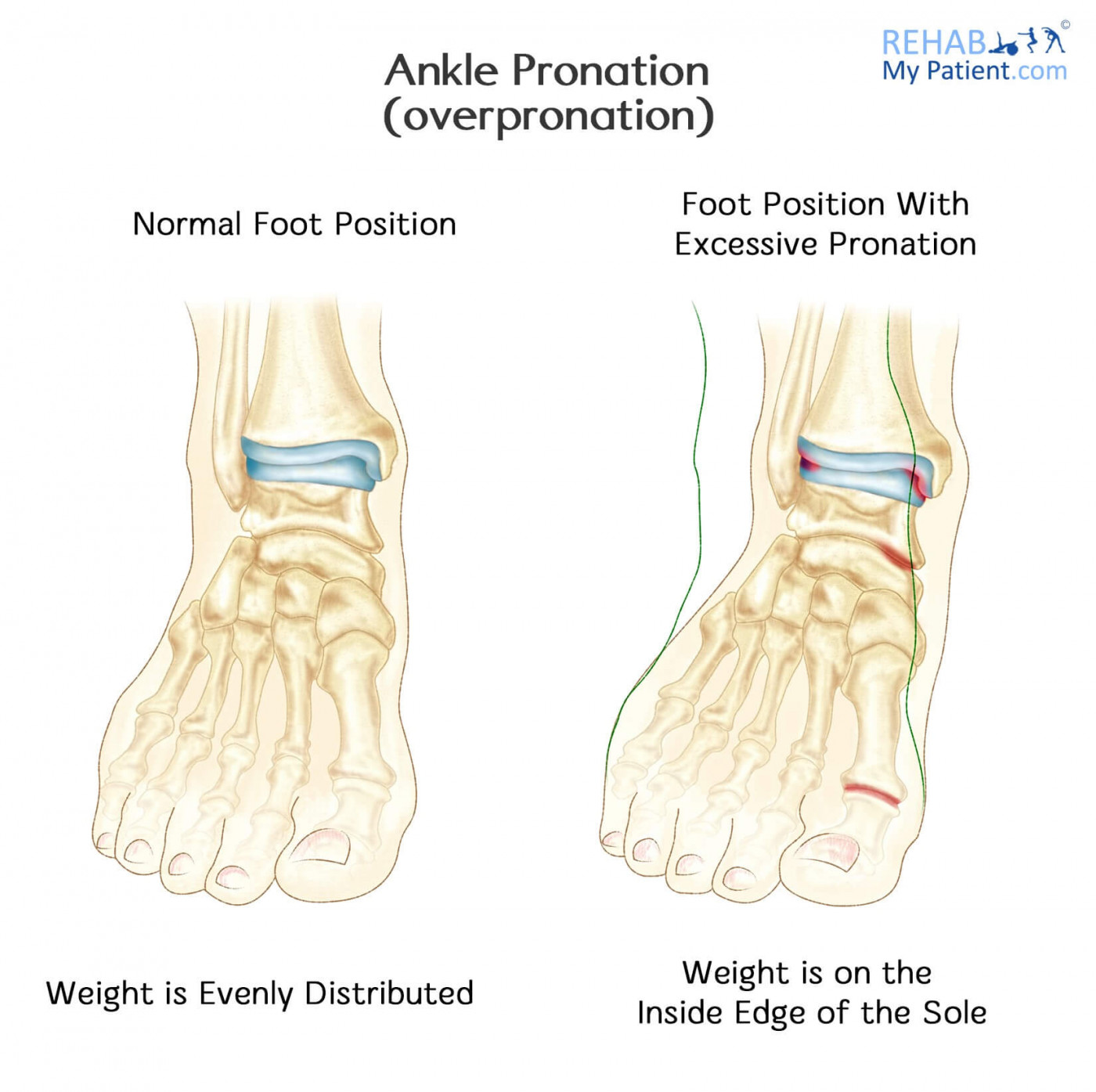 Ankle Pronation (Overpronation) | Rehab My Patient