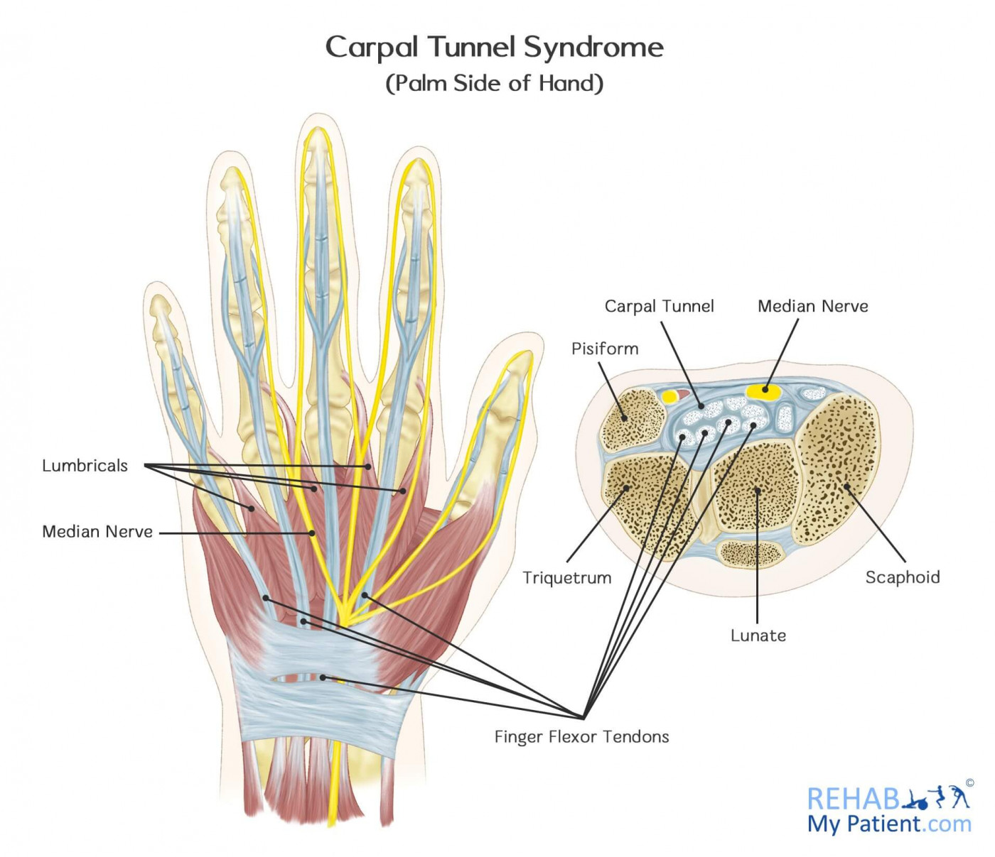 what causes carpal tunnel