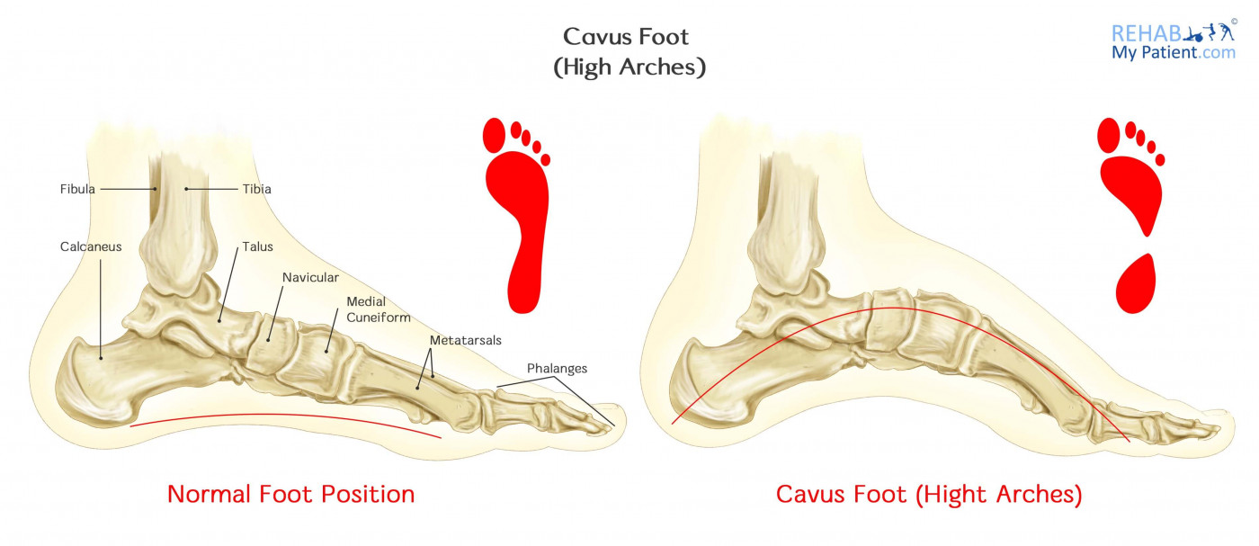 Cavus Foot (High Arches) | Rehab My Patient