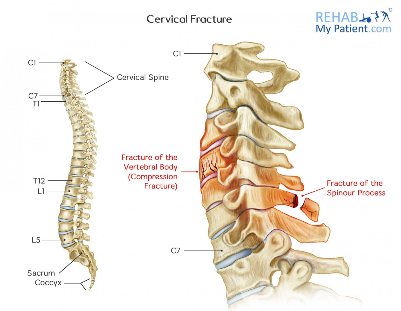 Non Displaced Cervical Fracture
