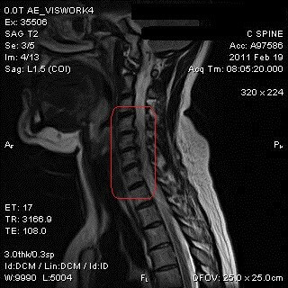 Cervical Spondylosis MRI