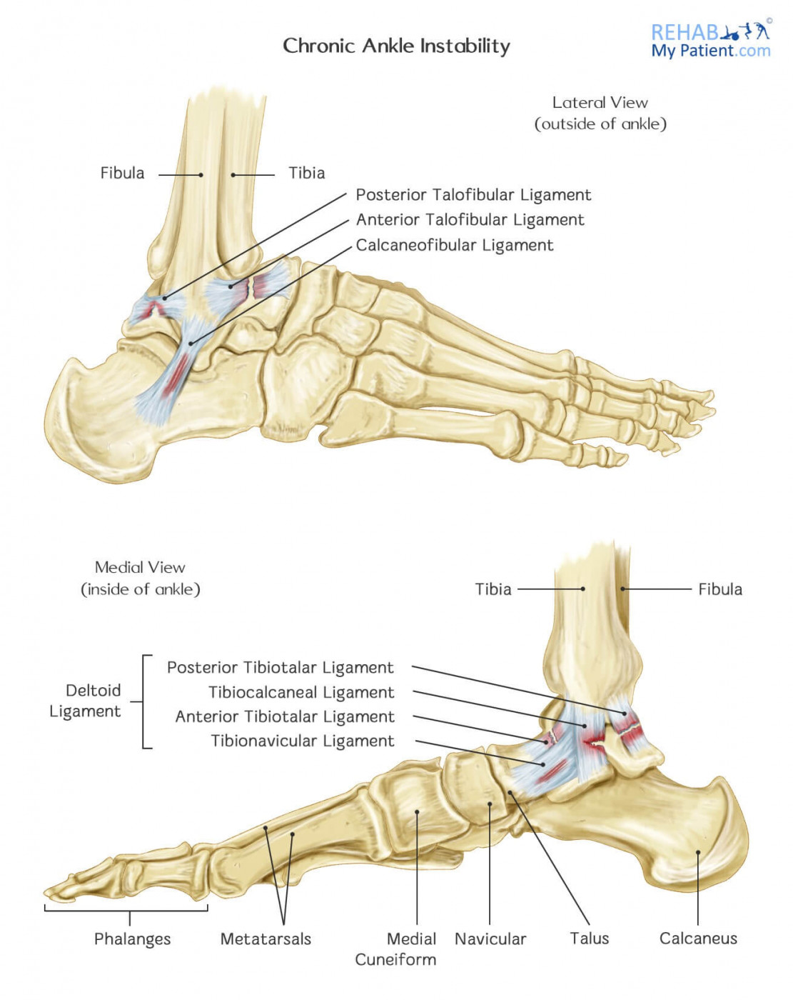 Chronic Ankle Instability | Rehab My Patient